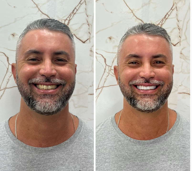 Antes e Depois - Transformação 9